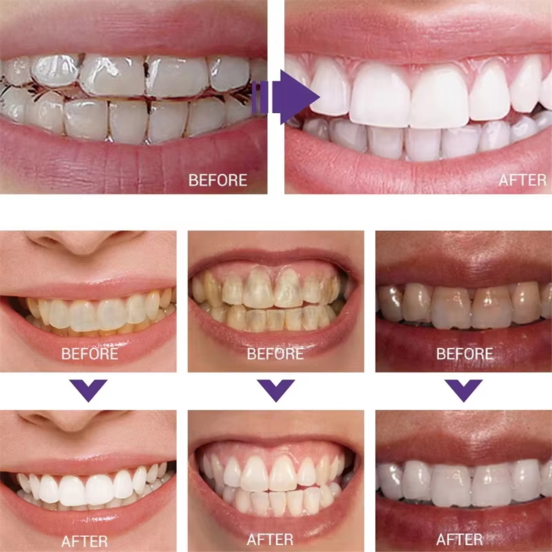 معجون أسنان لتبييض وتنظيف الأس - مراجعة Teeth Whitening Korea وسعره