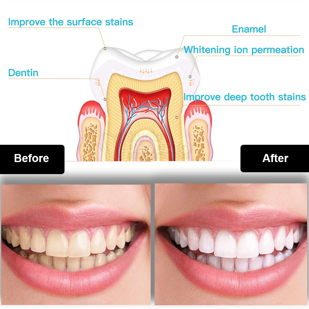 طقم تبييض الأسنان صغير 16 LED  - مراجعة Teeth Whitening Blue Light وسعره