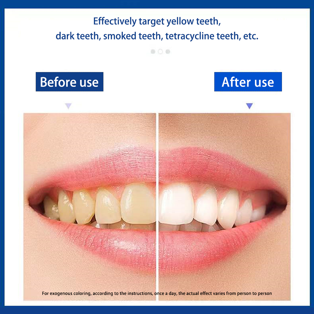 شرائط تبييض أسنان بيضاء ، تأثي - مراجعة Teeth Whitening Effects وسعره