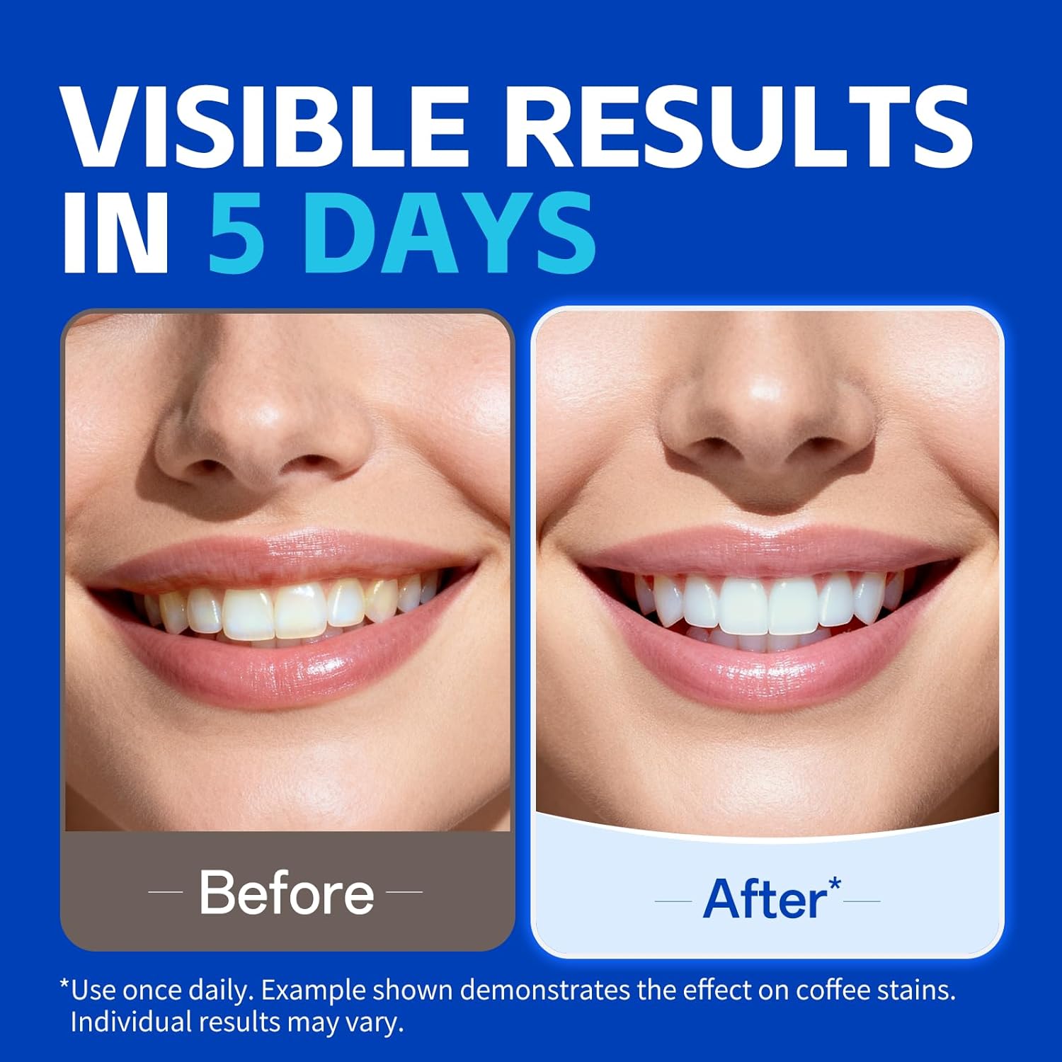 شرائط تبييض الأسنان من KHAZIX، - مراجعة Teeth Whitening Oil Pulling وسعره